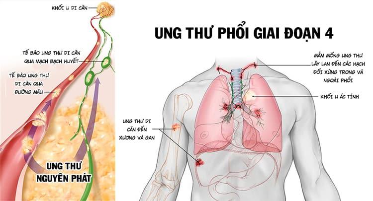 Ung thư phổi di căn xương (ung thư phổi giai đoạn 4)