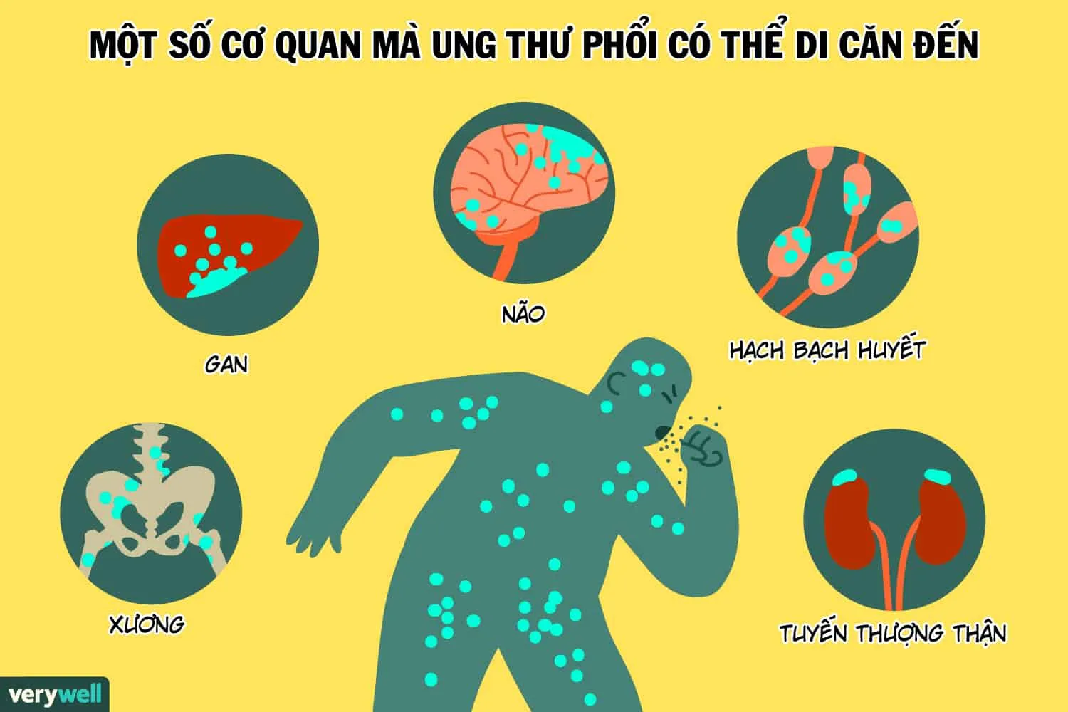 Ung thư phổi di căn xương
