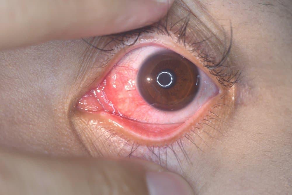 Triệu chứng viêm thượng củng mạc