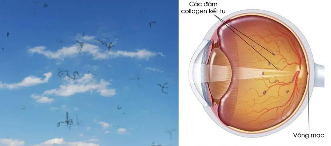 mắt nhìn thấy chấm đen