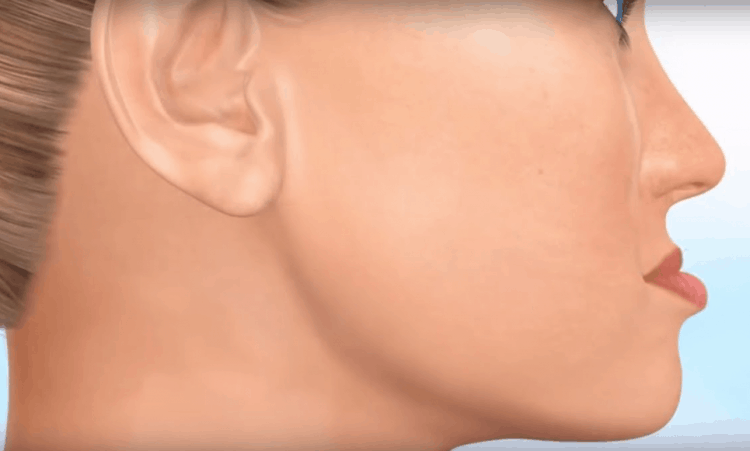 nguyên nhân cần niềng răng móm