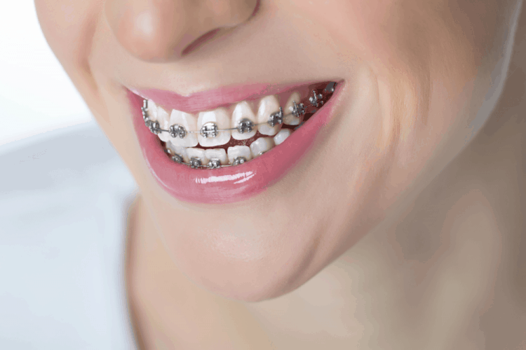 các loại niềng răng móm