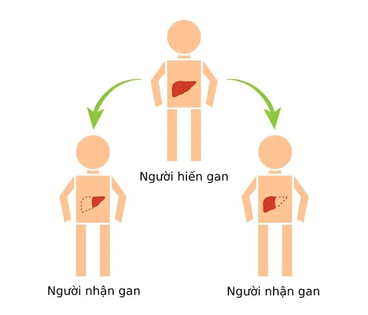 Phương pháp ghép gan