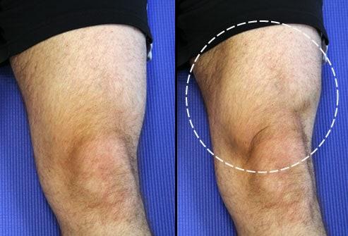 tập cơ đùi trước