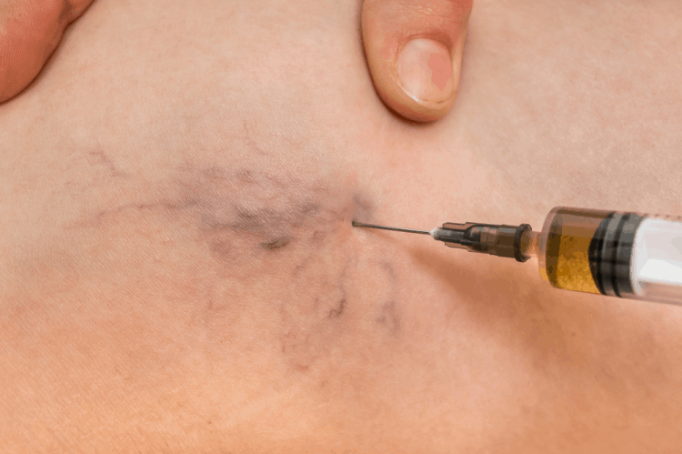 tĩnh mạch mạng nhện