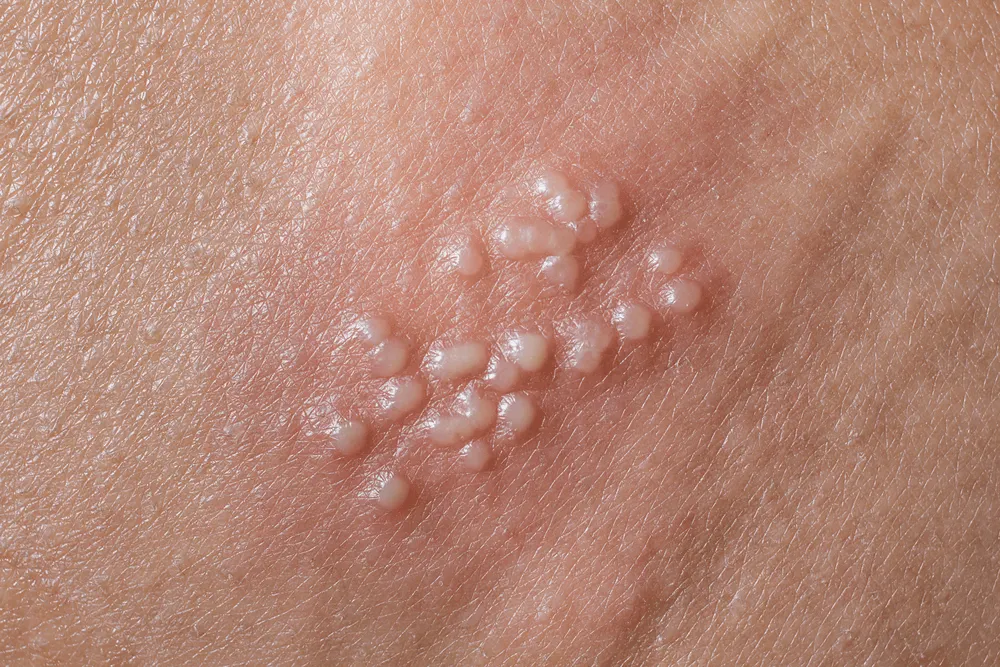 Bệnh herpes