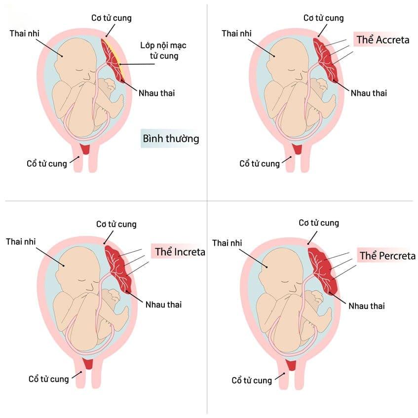 các thể nhau cài răng lược