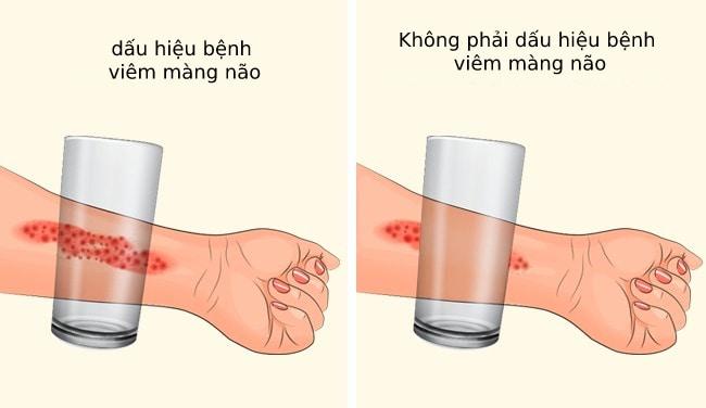 Triệu chứng viêm màng não