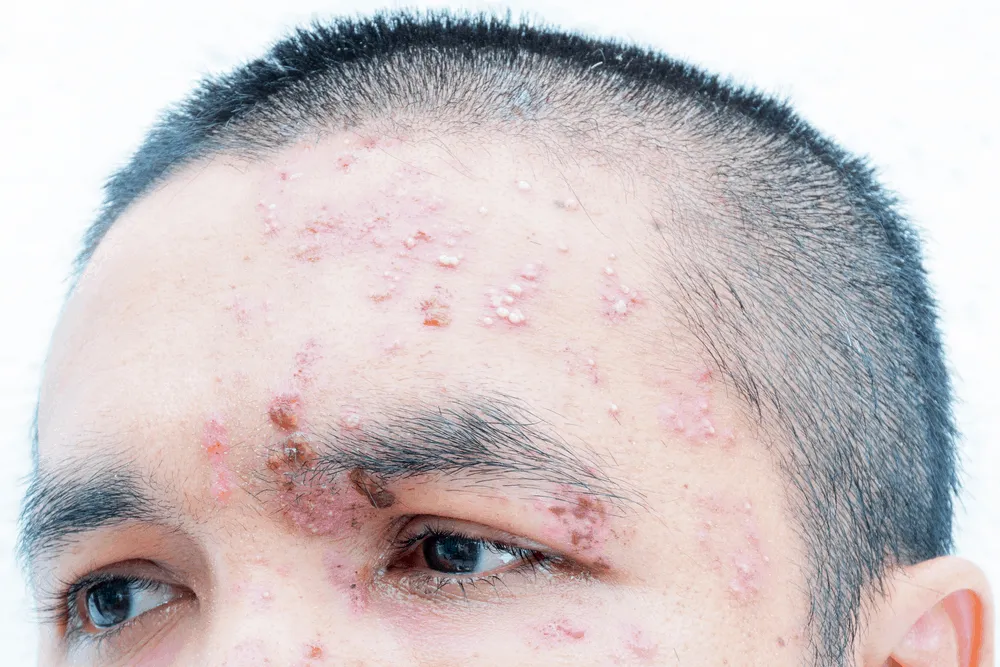 Dấu hiệu nhận biết bệnh zona thần kinh ở mắt