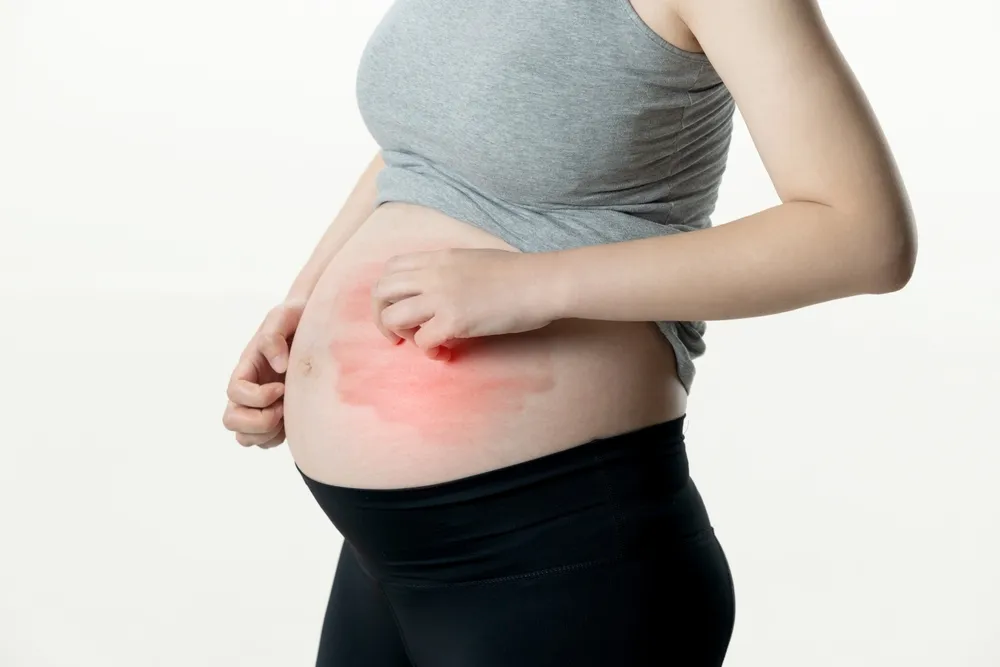 Bà bầu bị ngứa