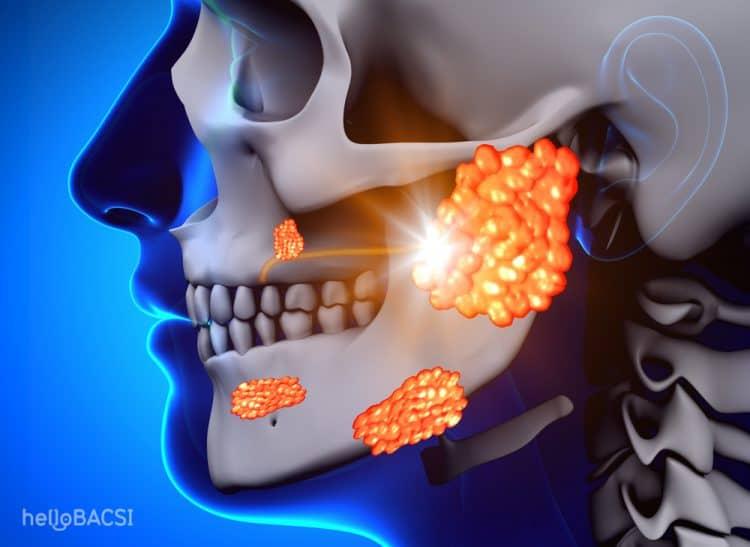 biến chứng của bệnh quai bị 