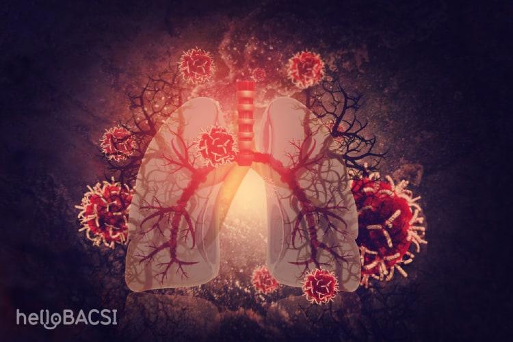 dấu hiệu nhiễm trùng máu ảnh hưởng tới phổi