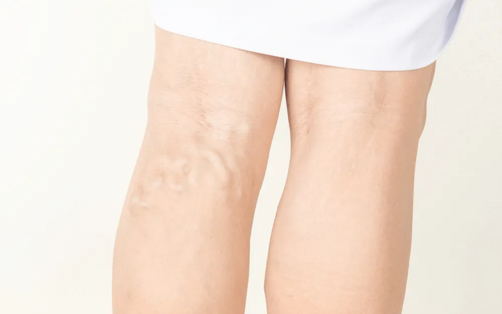 phẫu thuật giãn tĩnh mạch thừng tinh 2