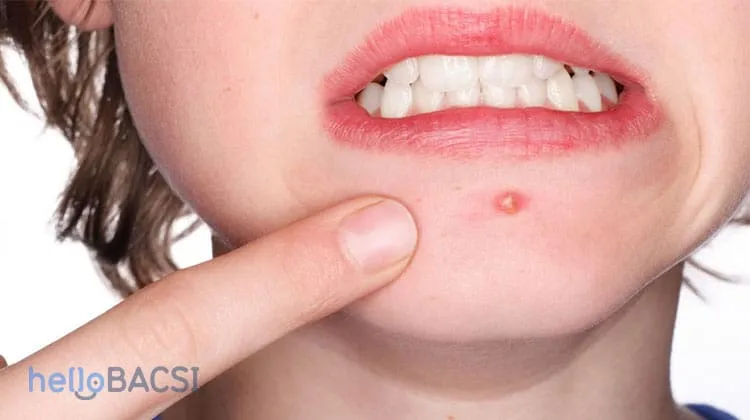 Bị tắc nghẽn lỗ chân lông là một trong những nguyên nhân hình thành mụn