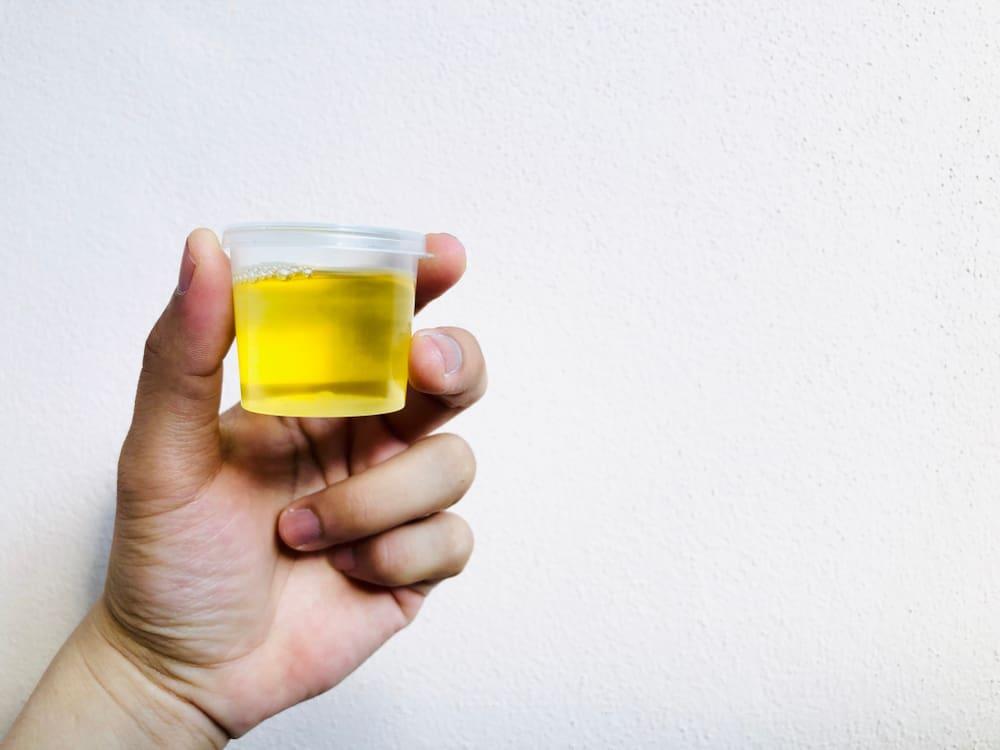 Triệu chứng sỏi thận qua màu nước tiểu