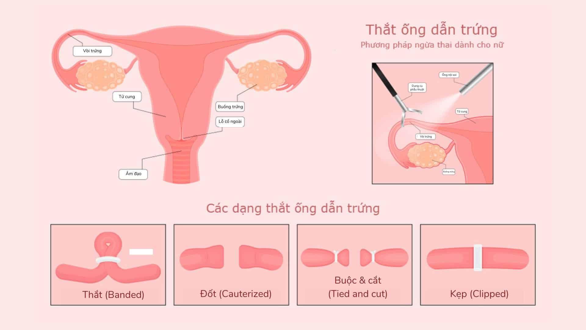 Tắc vòi trứng - Tắc ống dẫn trứng