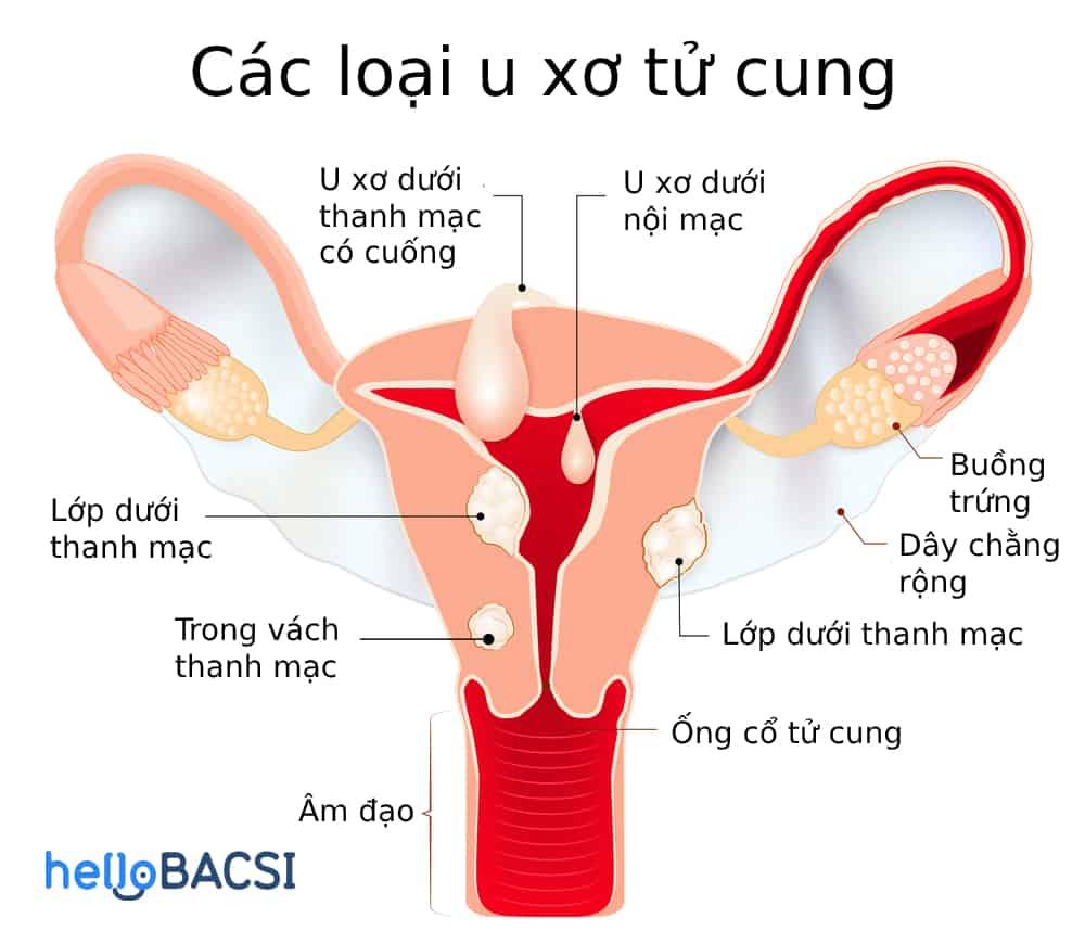 Các loại u xơ tử cung là bệnh phụ khoa thường gặp ở phụ nữ