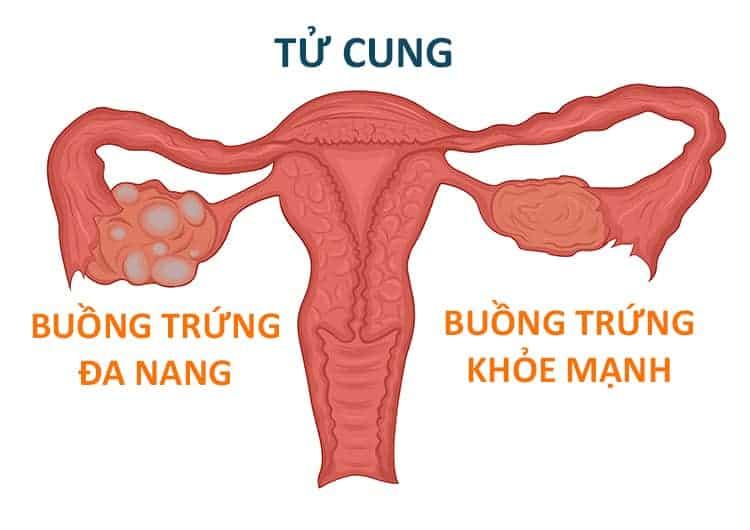 Buồng trứng đa nang - Nhóm các bệnh phụ khoa thường gặp ở phụ nữ (phổ biến)