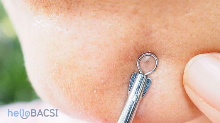 cách nặn mụn sử dụng các dụng cụ nặn mụn