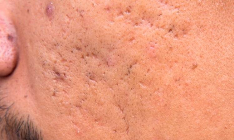 nguyên nhân gây sẹo lõm đáy nhọn