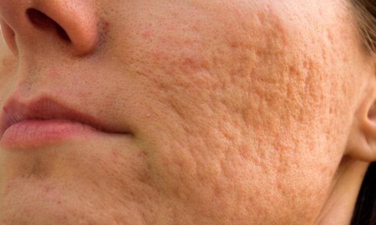 sẹo lõm chân tròn