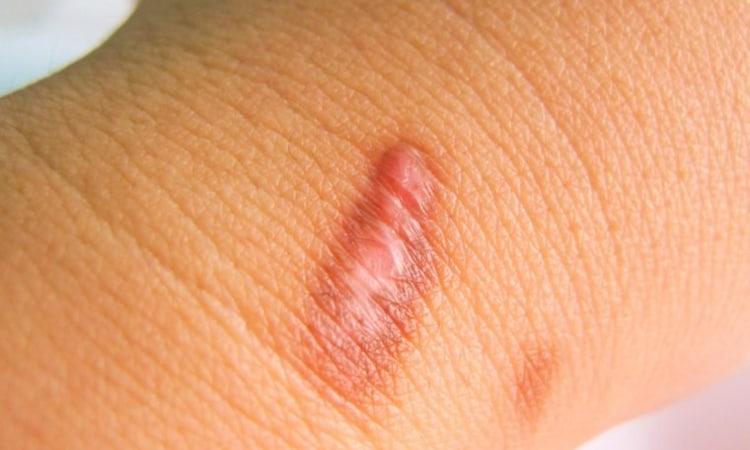 nguyên nhân gây sẹo lồi, sẹo phì đại