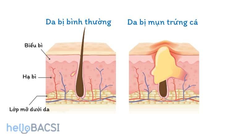 Tổng quan về mụn trứng cá