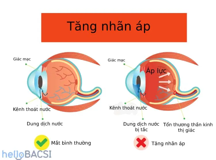 điều trị tăng nhãn áp, giảm triệu chứng