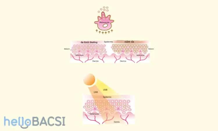 ánh mặt trời gây nám da