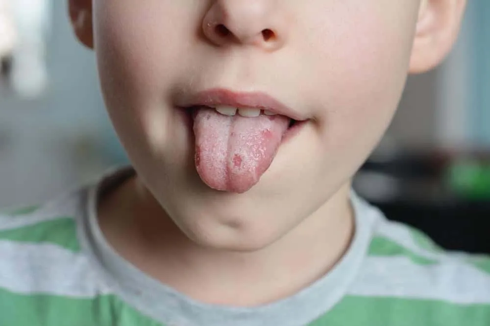 Nhiễm nấm Candida khiến môi bé bị khô