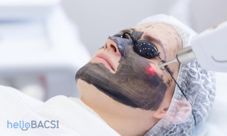 laser peel trị thâm mụn