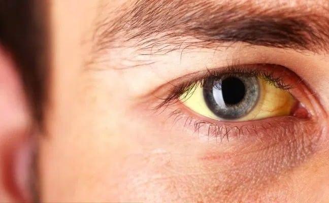 Vàng mắt là dấu hiệu viêm gan B