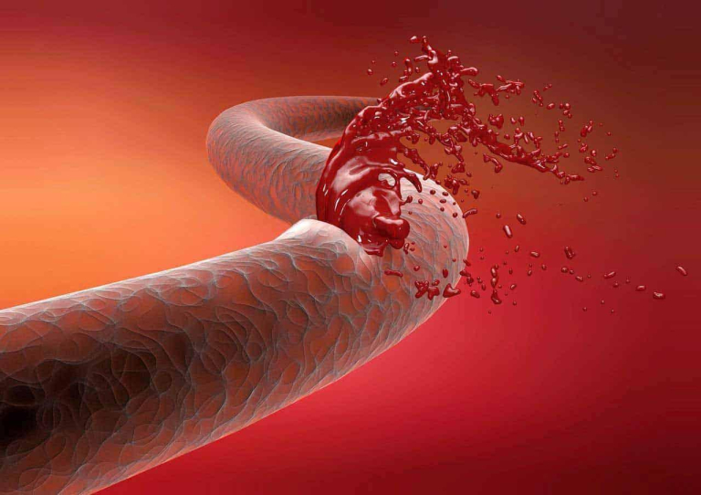 Biến chứng xơ gan gây xuất huyết