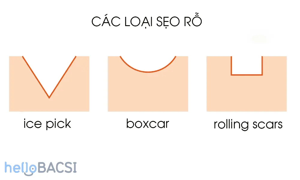 Các loại sẹo rỗ thường gặp