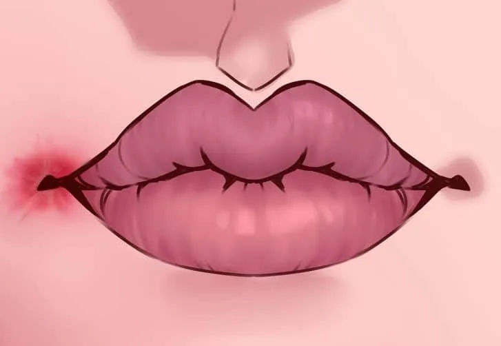 Dấu hiệu trên môi: Bị nứt khóe miệng