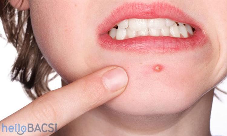 hình thành mụn trứng cá