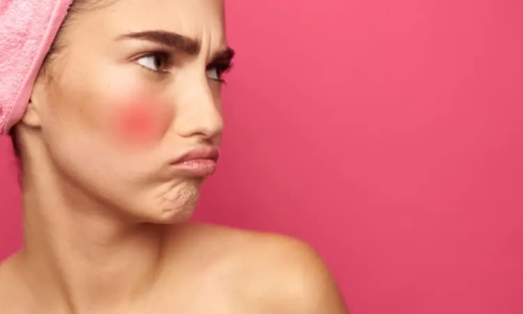 Trị mụn trứng cá bằng kem đánh răng gây hại cho da