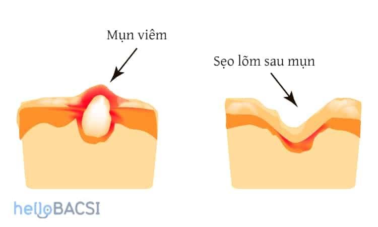 Mất bao lâu để làm mờ sẹo, thâm?