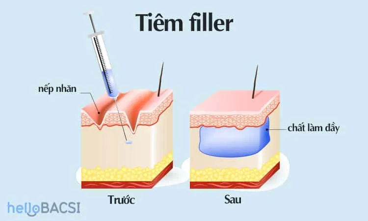 trươc và sau khi tiêm filler