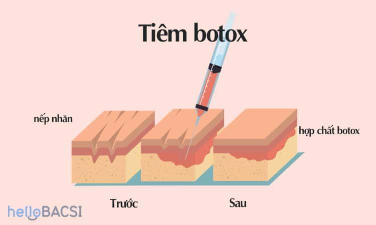 tiêm botox