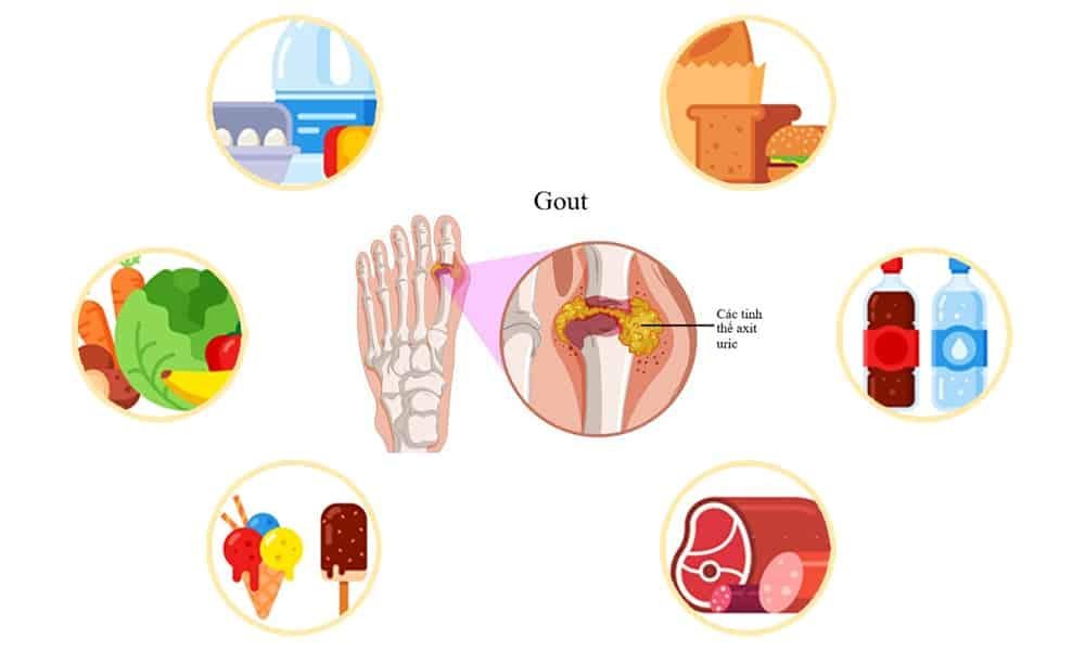 ăn uống ảnh hưởng đến bệnh gout