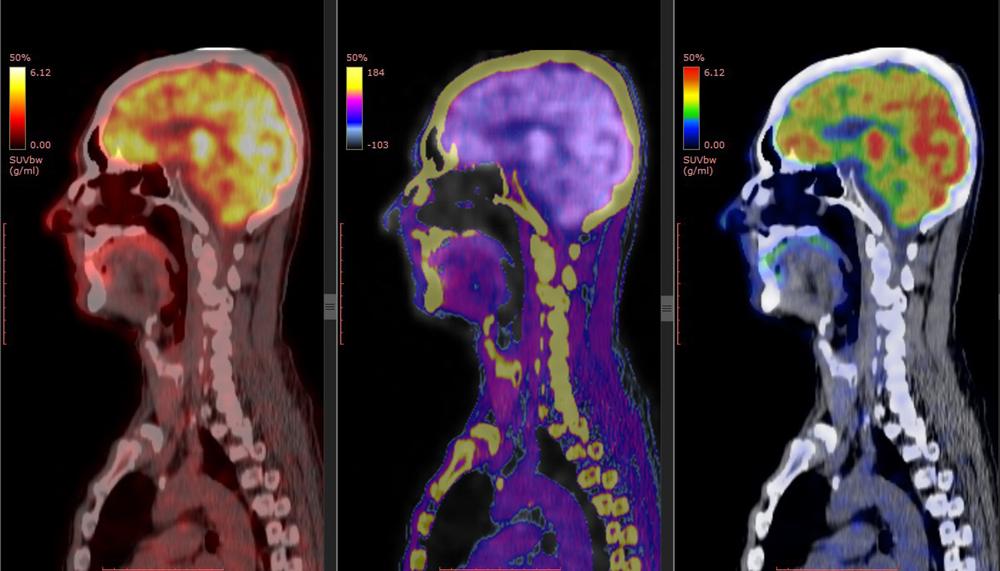 chụp spect là gì