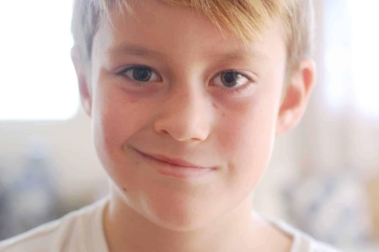 Liệt bell gây tê nửa mặt bên phải