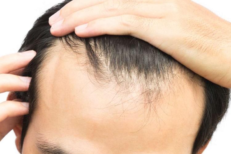 hormone DHT rụng tóc kiểu hói ở nam giới