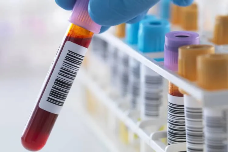 Xét nghiệm lipase trong chẩn đoán bệnh lý tuyến tụy