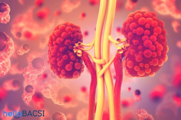 sỏi bàng quang có nguy hiểm không