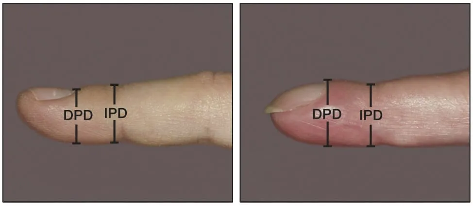 Chẩn đoán ngón tay dùi trống