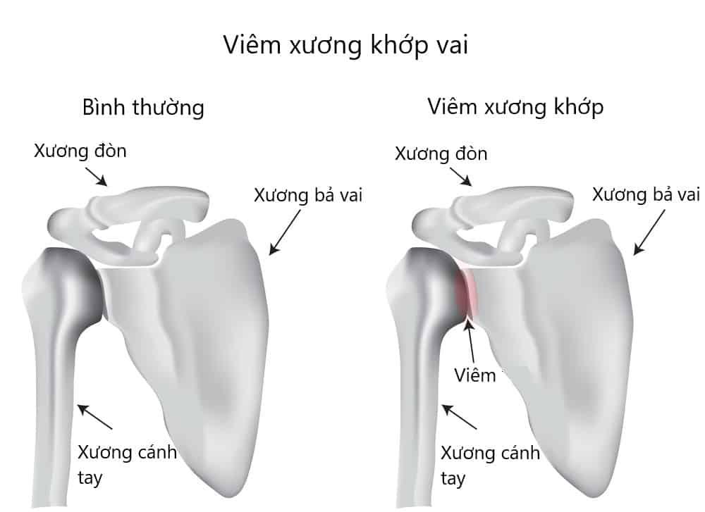 client_viêm xương khớp