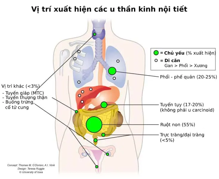 các vị trí u thần kinh nội tiết
