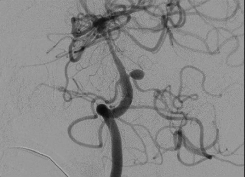 hình ảnh chụp mạch máu kỹ thuật số hóa xóa nền